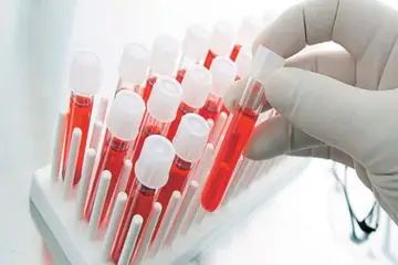 Ferritin Değeri Kaç Olmalı?